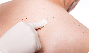 Skin Examination — Health Specialists on Fraser Coast, QLD