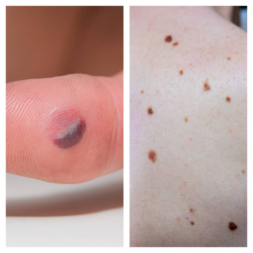 Blood Blister Vs Melanoma How To Tell Them Apart 