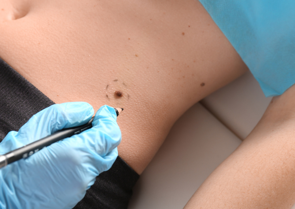 Applying Marks Onto Patient's Skin — Health Specialists in Fraser Coast, QLD